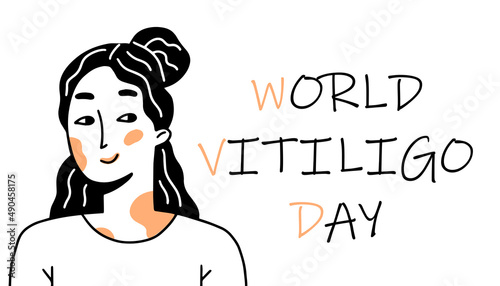World vitiligo day poster. A smiling girl with problematic vitiligo skin in a doodle style. Vector illustration.