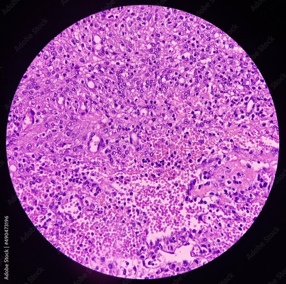 Ovarian cyst wall, luteal cyst, photo under microscope, photograph shows luteal cyst in the female ovary Ovarian cyst wall, luteal cyst, photo under microscope, photograph shows luteal cyst in the female ovary
