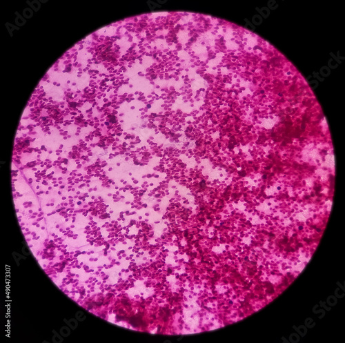 Microscopic image of vertebral lesion cytology, Inflammatory lesion, show polymorphs, lymphocytes, histiocytes,fibrous tissue, blood cell background. photo