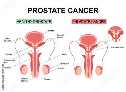 Prostate cancer on white background illustration. Anatomy of the male reproductive organs. Healthy prostate and cancer. Infographics, urology. Medical poster, penis, testicles, prostate. flat cartoon 