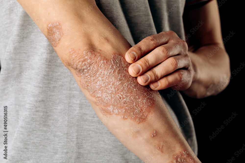 Acute psoriasis on the elbows is an autoimmune incurable dermatological