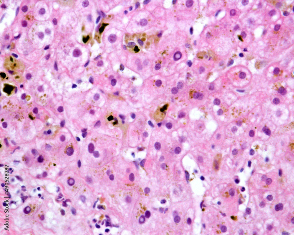 Human liver. Cholestasis. Bile pigment