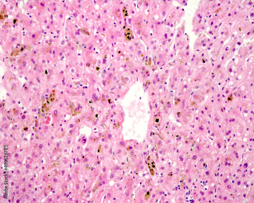 Canvastavla Human liver. Cholestasis. Bile pigment