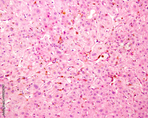 Canvastavla Human liver. Cholestasis. Bile pigment