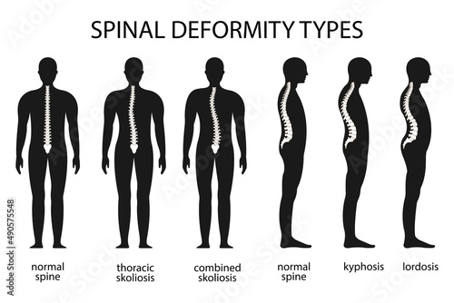 Spine deformity vector illustration. Kyphosis, lordosis spine infographic. Diagram with spine curvature and healthy spine. Posture defect. Medical, educational and scientific banner