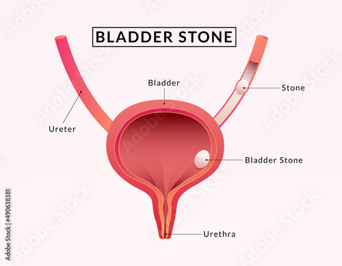 Stones in the bladder. Human Bladder Anatomy.  medical illustration. photo