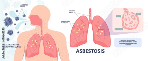 Asbestos breath chest pain testes ascites Hydrocele scrotum Swollen Difficulty fluid pleura testicle tunica vaginalis dust tract safe safety carcinogen smoking hazard danger tissue toxic silica copd
