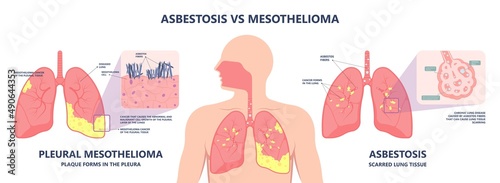 Asbestos breath chest pain testes ascites Hydrocele scrotum Swollen Difficulty fluid pleura testicle tunica vaginalis dust tract safe safety carcinogen smoking hazard danger tissue toxic silica copd photo