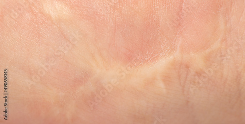 Scar on human skin as a background.