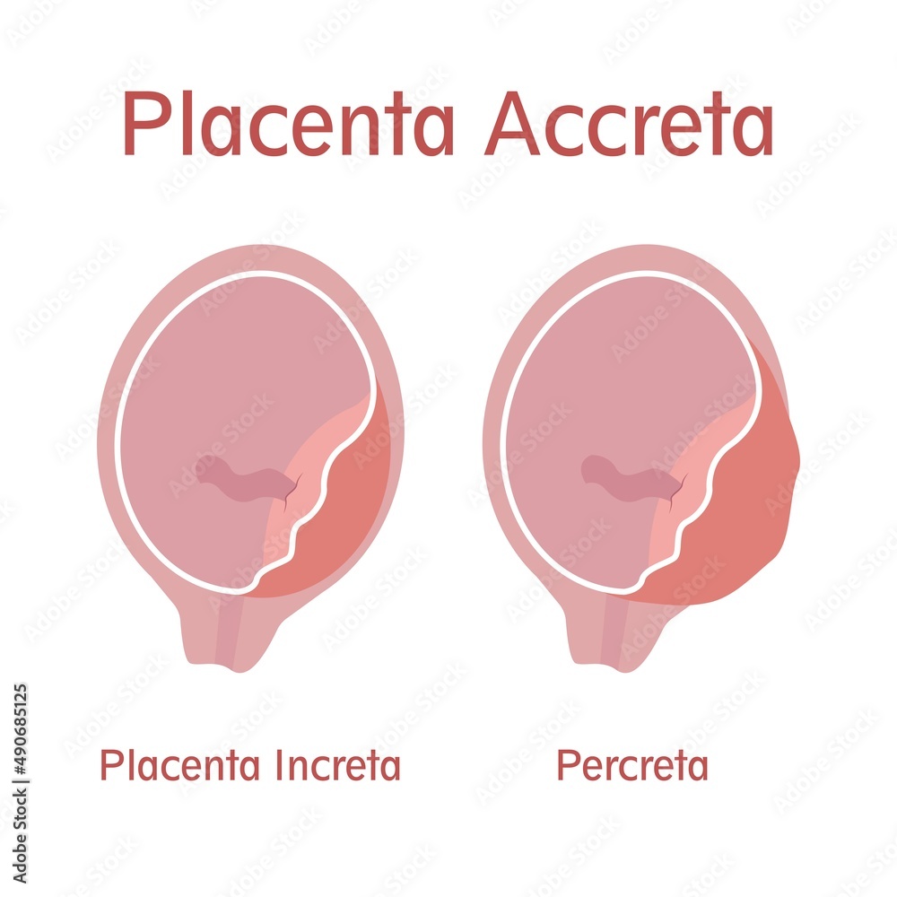 Types Of Placenta Accreta Placenta Increta And Percreta Stock Vector 