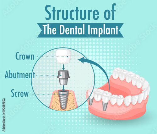 Infographic of human in structure of the dental implant