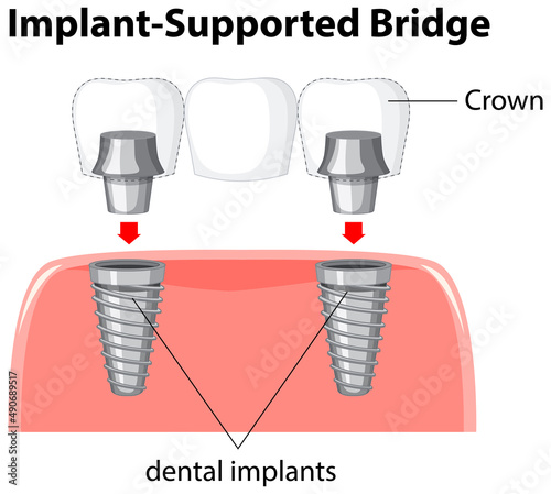 Infographic of human in structure of the dental implant
