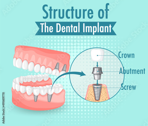 Infographic of human in structure of the dental implant