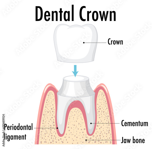Infographic of human in dental crown