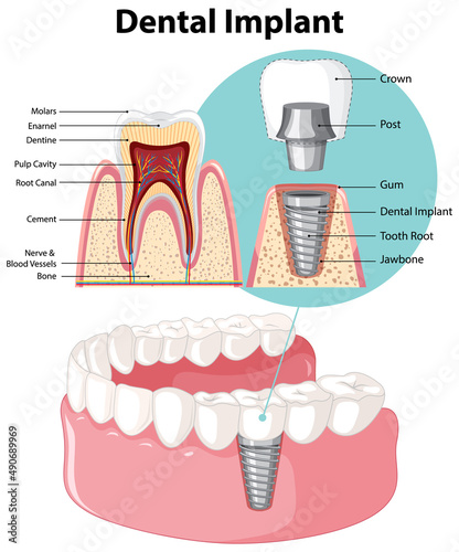 Infographic of human in structure of the dental implant