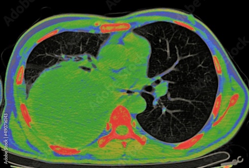 pleural empyema, color axial chest ct scan 
 photo