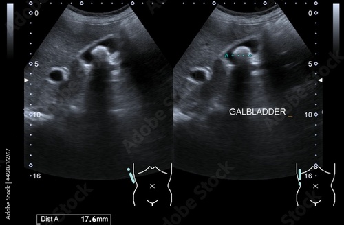 An ultrasound image of gallstone
 photo
