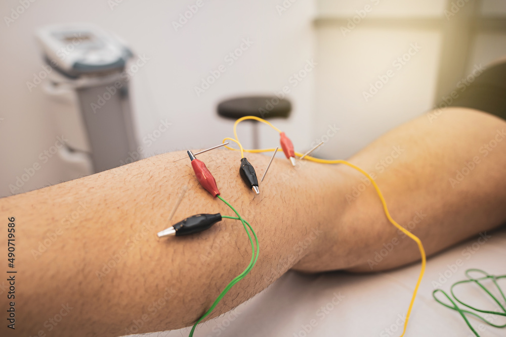 electroacupuncture with the needle connection machine used by the  acupuncturist in men. Electrical stimulation in physiotherapy to the twin  of a young man in the physiotherapy center. Stock Photo