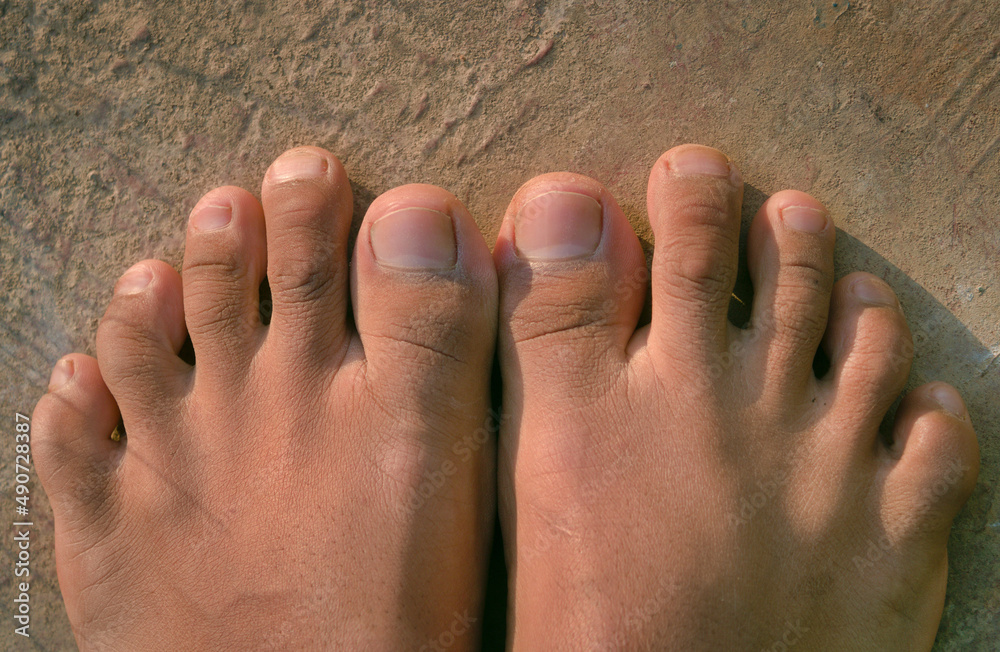 female foot with second toe longer than a big toe. Morton's foot, Greek foot,  royal toe, Turkey toe, Sheppard's toe, Viking toe, Morton's syndrome, long  toe or boss toe. Photos | Adobe