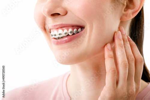 Smile with Braces Orthodontic Treatment. Dental Care Concept. Beautiful Woman Healthy Smile close up. Closeup Ceramic and Metal Brackets on Teeth. Beautiful Female