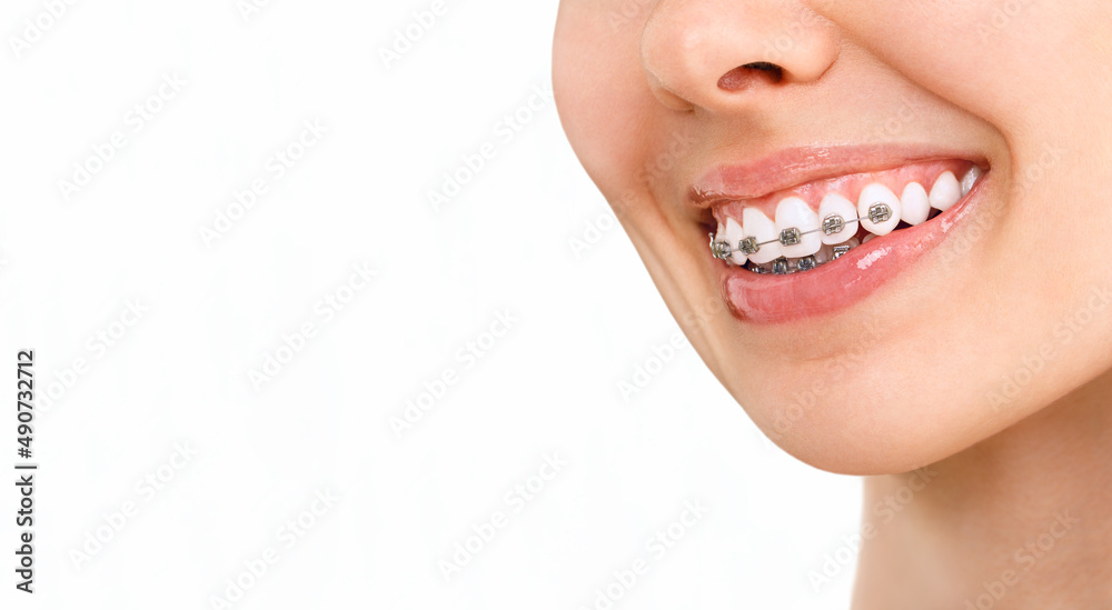 Obraz premium Smile with Braces Orthodontic Treatment. Dental Care Concept. Beautiful Woman Healthy Smile close up. Closeup Ceramic and Metal Brackets on Teeth. Beautiful Female