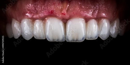 dental treatment case by ceramic crowns and veneers