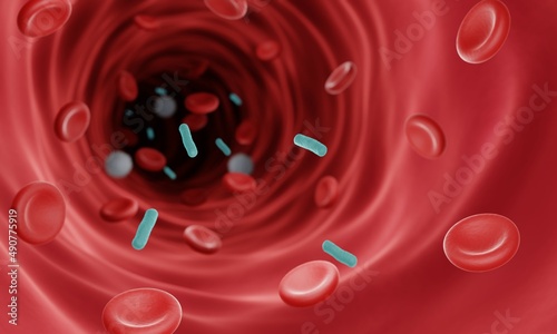 Bacterial sepsis, Bloodstream infection  photo