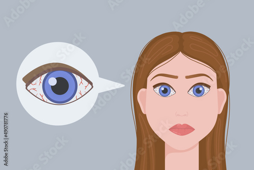 conjunctivitis illustration