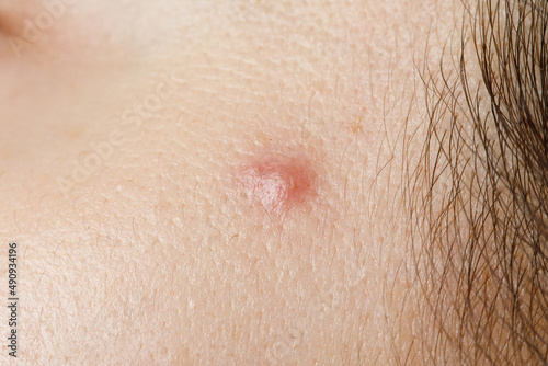 macro photo of a pimple photo