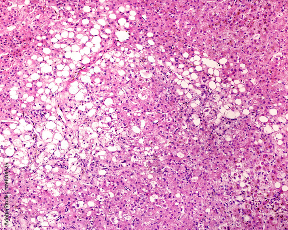 Fototapeta premium Human liver. Cirrhosis