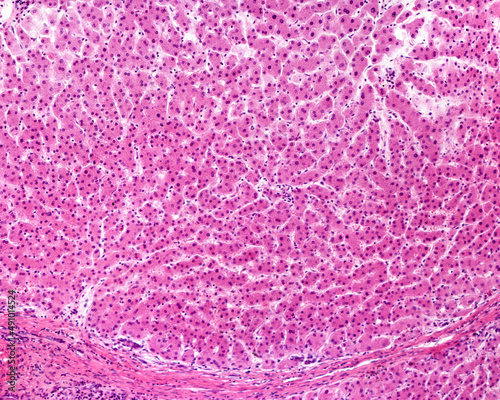 Human liver. Cirrhosis photo