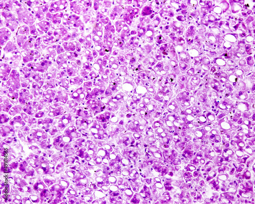 Human liver. Steatosis. PAS stain