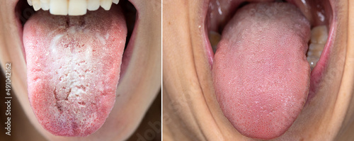 Cuadro en lienzo Comparison between a tongue with candidiasis and a healthy tongue