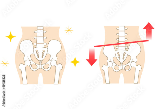 Left-right tilted pelvis and posture. photo