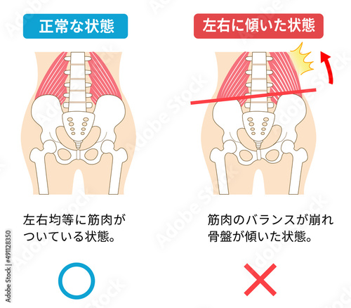 左右に傾いた骨盤と姿勢の関係