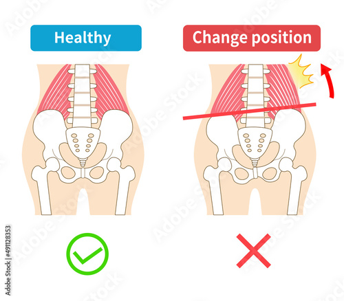 Left-right tilted pelvis and quadratus lumborum. photo