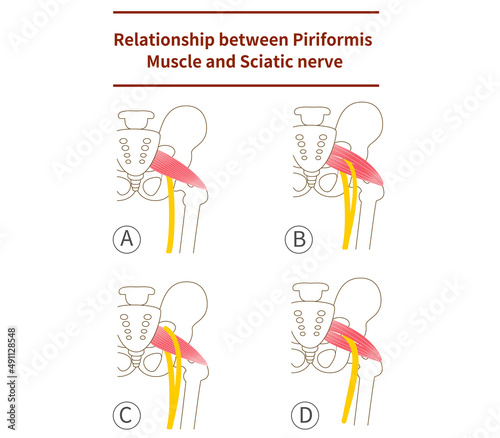 Illustration of piriformis and sciatic nerve photo