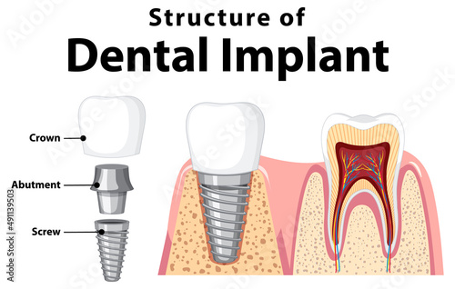 Structure of the dental implant on white background