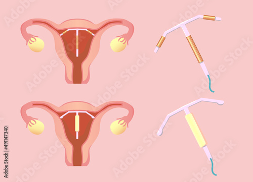 intrauterine device - IUD  vector illustration 