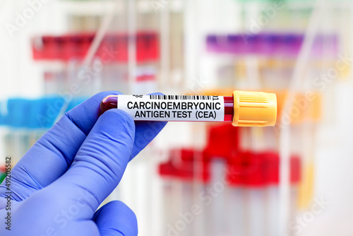doctor with Blood tube and needle for CEA Carcinoembryonic Antigen test. Blood sample of patient for Carcinoembryonic Antigen test CEA in laboratory photo