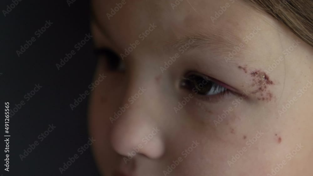 Close-up of a painful wound near the eye of a 6-7 year old girl. Close-up of a painful wound near the eye of a 6-7 year old girl.