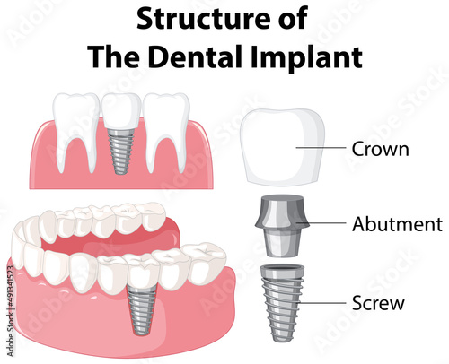 Infographic of human in structure of the dental implant