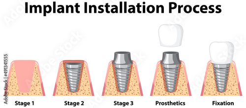 Infographic of human in implant installation process