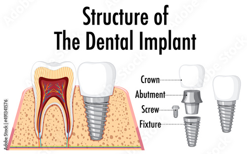 Infographic of human in structure of the dental implant