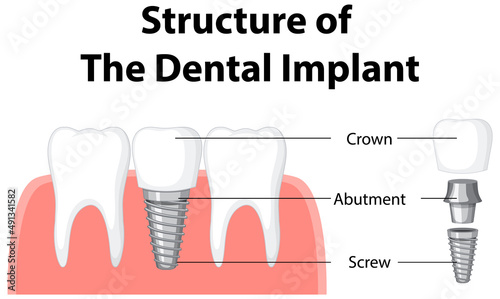 Infographic of human in structure of the dental implant