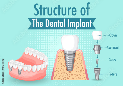 Infographic of human in structure of the dental implant