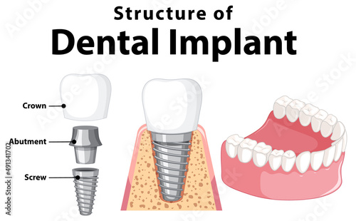 Infographic of human in structure of the dental implant