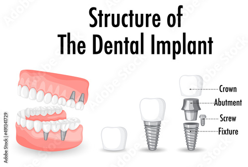 Infographic of human in structure of the dental implant