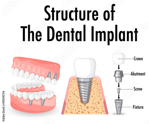 Infographic of human in structure of the dental implant