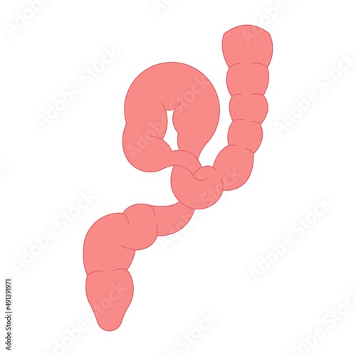 ileus bowel toxic small midgut cecal colon tract Hirschsprung's gastric Ladd band large hiatal hernia cancer tumor swollen crohn's x-ray meckel's twist blocked birth defect infant children pain short